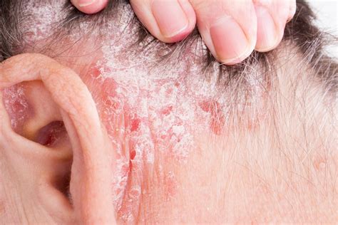 Dermatitis por qué da