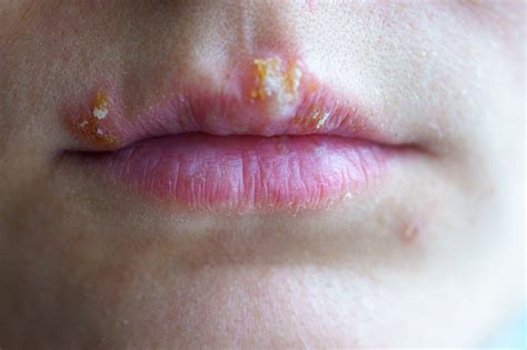 Herpes bucal por qué sale