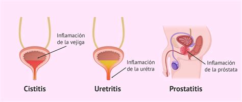 Infección urinaria por qué da